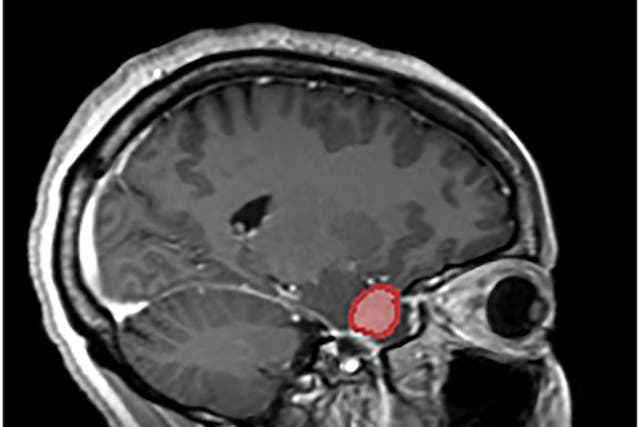 <p>Undated handout image issued by Leeds Teaching Hospitals NHS Trust of an MRI scan used by surgeons to visualise Ruvimbo Kaviya's tumour, who became the first person in the UK to receive groundbreaking surgery to remove a tumour through her eye socket.</p>