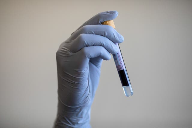 <p>Alzhemier’s disease could be diagnosed up to a decade earlier after the world’s biggest study of proteins is completed</p>