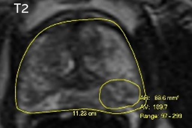 <p>An MRI image showing only one tumour found. (Heriot-Watt/PA)</p>