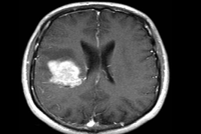 <p>Brain scan shows the white mass of a solid tumour</p>